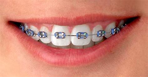 que es mejor los brackets esteticos o metalicos|champagne vs metal braces.